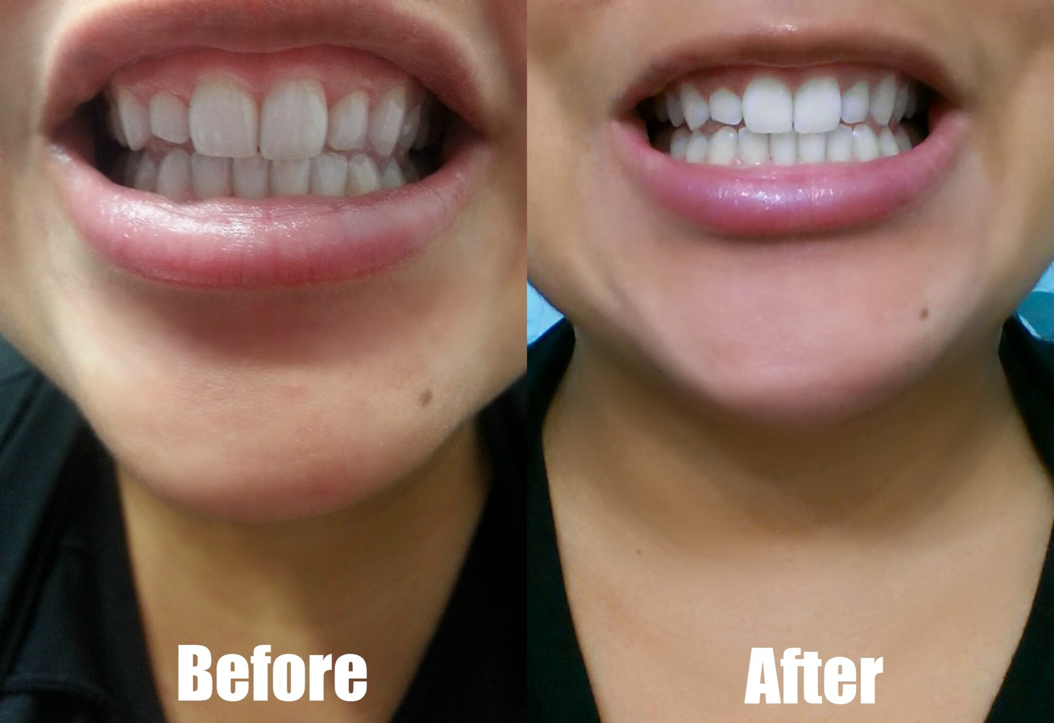 Отбеливание зубов углем до и после