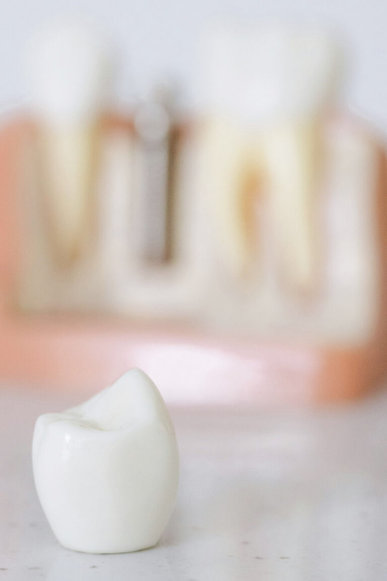 Detailed close-up of a dental prosthetic with a sterilized and blurred dental model background. This article covers how dental implants compare to other tooth replacement options.
