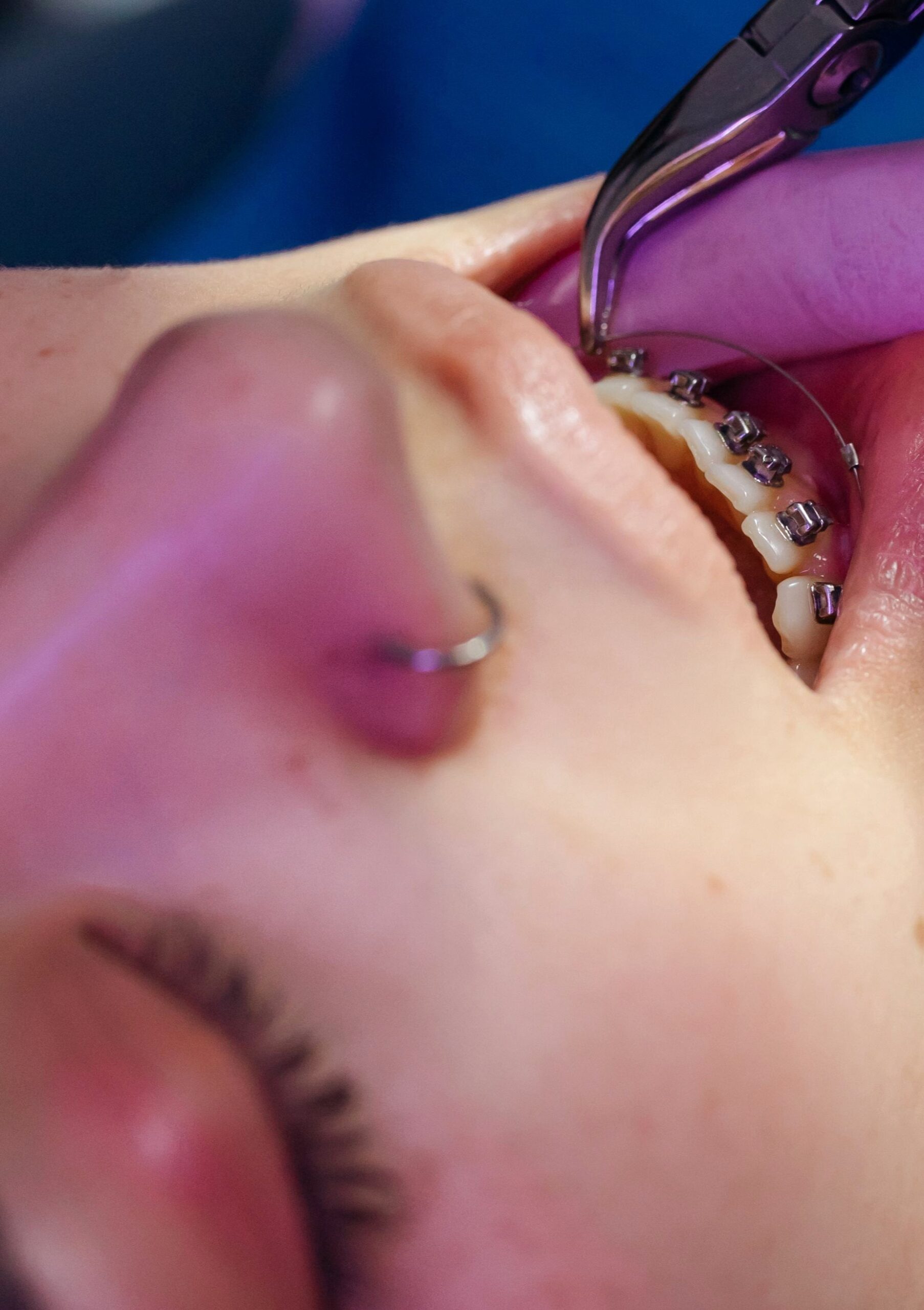 A close-up view of a dental procedure involving braces on a teen. This article shares tips for protecting your mouth during orthodontic treatment.