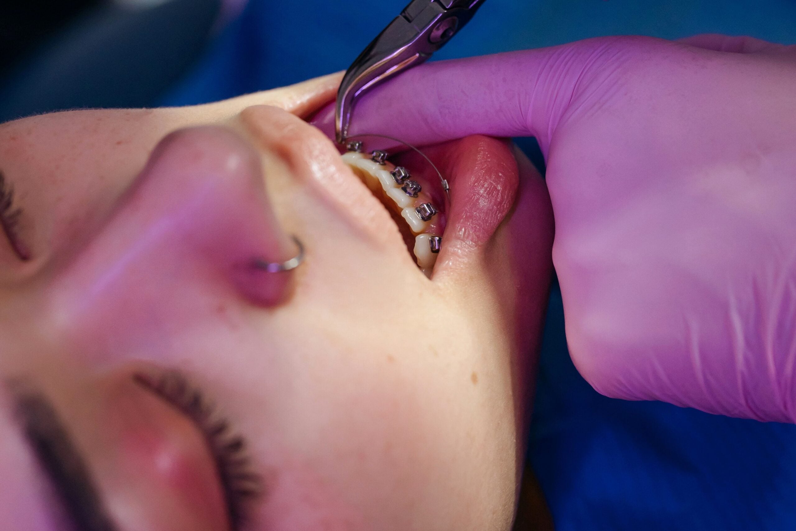 A close-up view of a dental procedure involving braces on a teen. This article shares tips for protecting your mouth during orthodontic treatment.